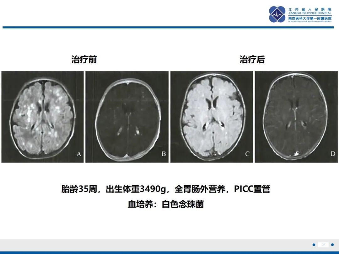 影像PPT - 【PPT】Baby\'s breath(满天星)​—新生儿侵袭性念珠菌病-38