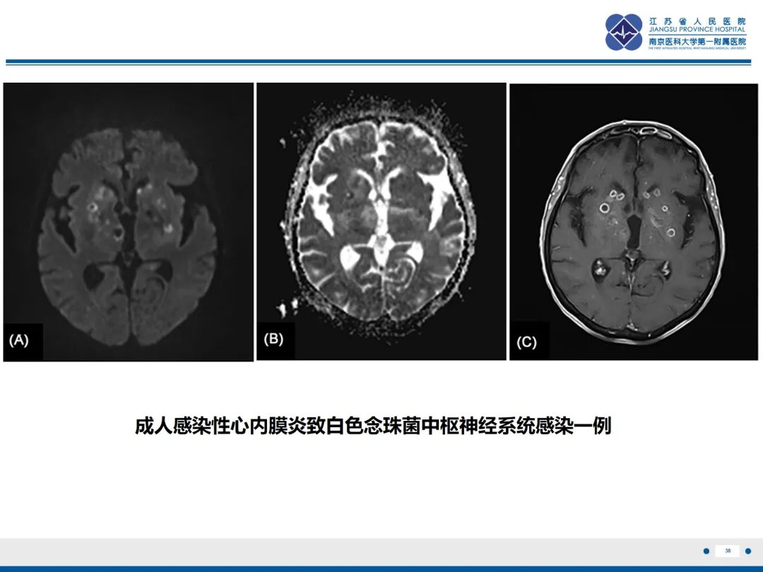 影像PPT - 【PPT】Baby\'s breath(满天星)​—新生儿侵袭性念珠菌病-39