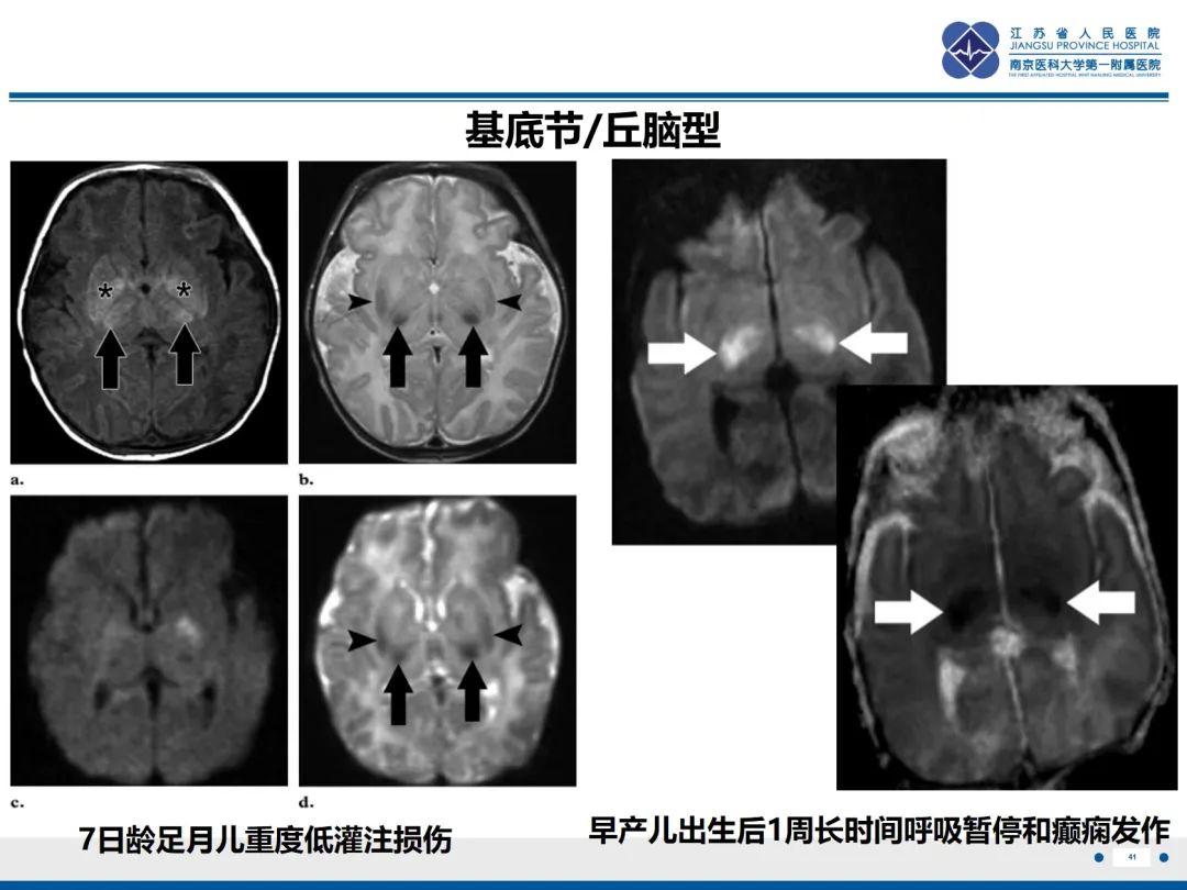 影像PPT - 【PPT】Baby\'s breath(满天星)​—新生儿侵袭性念珠菌病-42