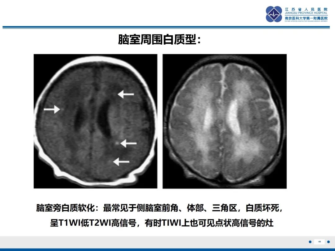 影像PPT - 【PPT】Baby\'s breath(满天星)​—新生儿侵袭性念珠菌病-45