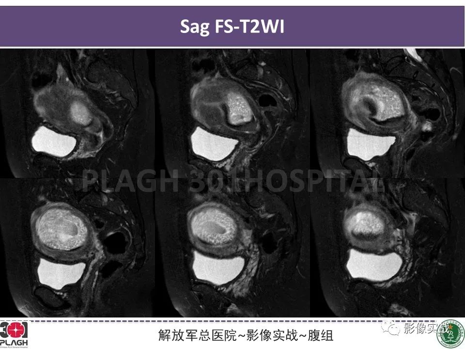 影像PPT - 【病例】葡萄胎1例MR影像-5