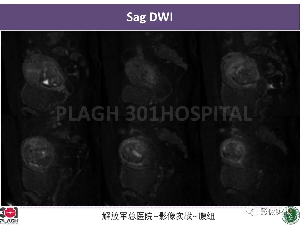 影像PPT - 【病例】葡萄胎1例MR影像-6