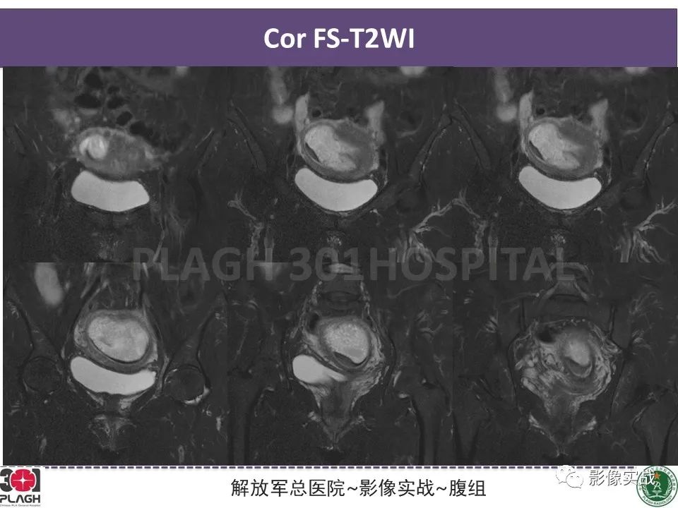 影像PPT - 【病例】葡萄胎1例MR影像-8