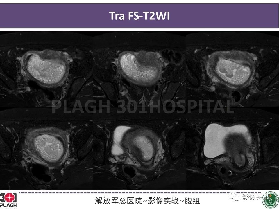 影像PPT - 【病例】葡萄胎1例MR影像-9