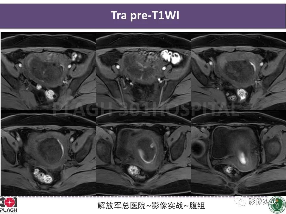 影像PPT - 【病例】葡萄胎1例MR影像-10