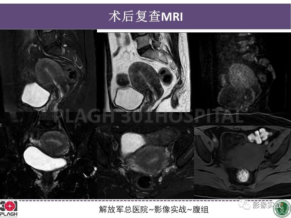 影像PPT - 【病例】葡萄胎1例MR影像-25