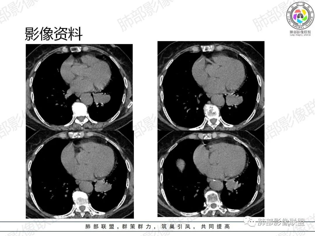 影像PPT - 【病例】罕见的肺滑膜肉瘤1例CT-6 影像PPT - 【病例】罕见的肺滑膜肉瘤1例CT-6