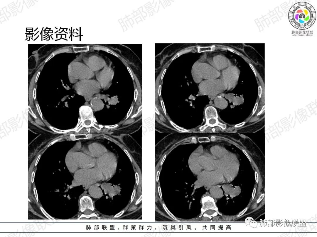 影像PPT - 【病例】罕见的肺滑膜肉瘤1例CT-5 影像PPT - 【病例】罕见的肺滑膜肉瘤1例CT-5