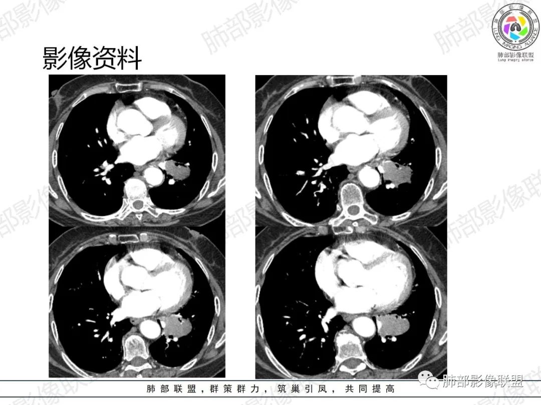影像PPT - 【病例】罕见的肺滑膜肉瘤1例CT-7 影像PPT - 【病例】罕见的肺滑膜肉瘤1例CT-7