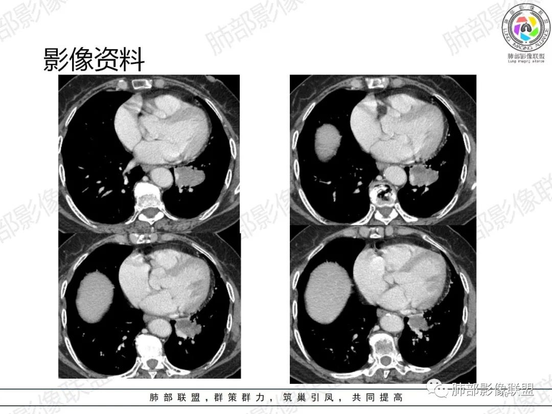 影像PPT - 【病例】罕见的肺滑膜肉瘤1例CT-10 影像PPT - 【病例】罕见的肺滑膜肉瘤1例CT-10