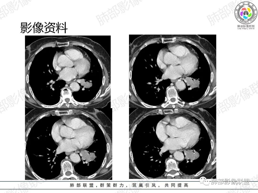 影像PPT - 【病例】罕见的肺滑膜肉瘤1例CT-9 影像PPT - 【病例】罕见的肺滑膜肉瘤1例CT-9