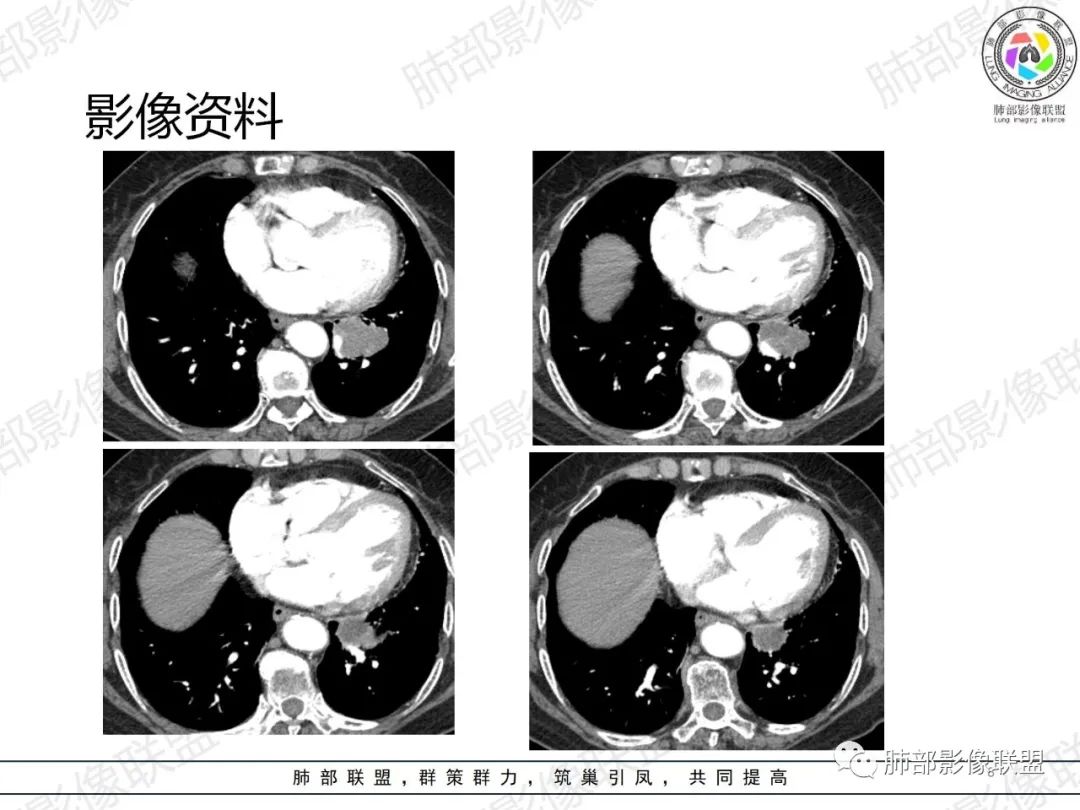 影像PPT - 【病例】罕见的肺滑膜肉瘤1例CT-8 影像PPT - 【病例】罕见的肺滑膜肉瘤1例CT-8