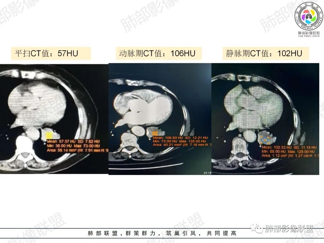 影像PPT - 【病例】罕见的肺滑膜肉瘤1例CT-11 影像PPT - 【病例】罕见的肺滑膜肉瘤1例CT-11