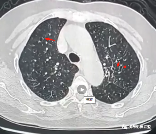 影像PPT - 【病例】罕见的肺滑膜肉瘤1例CT-17 影像PPT - 【病例】罕见的肺滑膜肉瘤1例CT-17