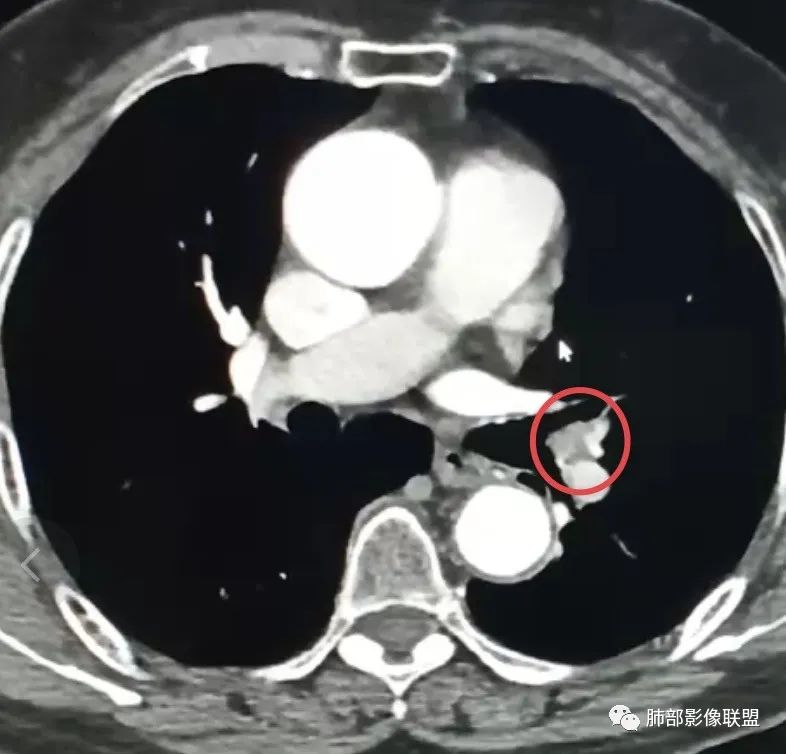 影像PPT - 【病例】罕见的肺滑膜肉瘤1例CT-15 影像PPT - 【病例】罕见的肺滑膜肉瘤1例CT-15