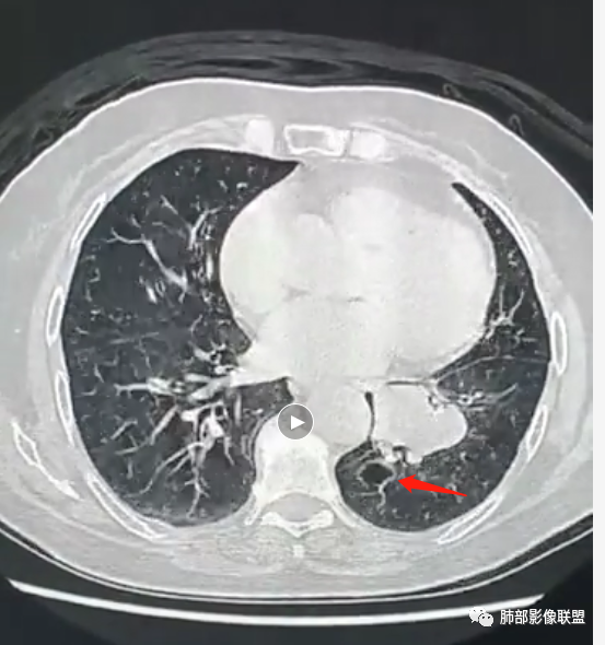 影像PPT - 【病例】罕见的肺滑膜肉瘤1例CT-18 影像PPT - 【病例】罕见的肺滑膜肉瘤1例CT-18
