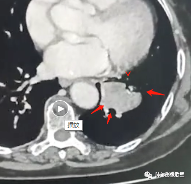 影像PPT - 【病例】罕见的肺滑膜肉瘤1例CT-23 影像PPT - 【病例】罕见的肺滑膜肉瘤1例CT-23