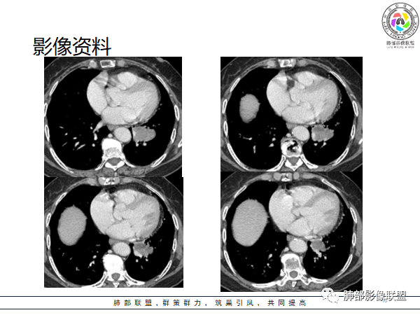 影像PPT - 【病例】罕见的肺滑膜肉瘤1例CT-25 影像PPT - 【病例】罕见的肺滑膜肉瘤1例CT-25