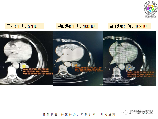 影像PPT - 【病例】罕见的肺滑膜肉瘤1例CT-26 影像PPT - 【病例】罕见的肺滑膜肉瘤1例CT-26
