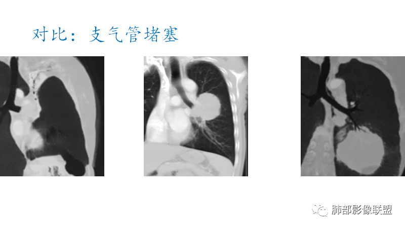 影像PPT - 【病例】罕见的肺滑膜肉瘤1例CT-28 影像PPT - 【病例】罕见的肺滑膜肉瘤1例CT-28