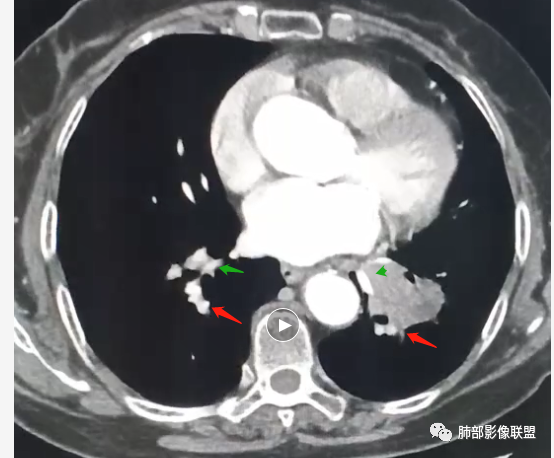 影像PPT - 【病例】罕见的肺滑膜肉瘤1例CT-27 影像PPT - 【病例】罕见的肺滑膜肉瘤1例CT-27