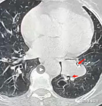 影像PPT - 【病例】罕见的肺滑膜肉瘤1例CT-22 影像PPT - 【病例】罕见的肺滑膜肉瘤1例CT-22