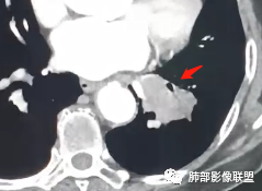 影像PPT - 【病例】罕见的肺滑膜肉瘤1例CT-1 影像PPT - 【病例】罕见的肺滑膜肉瘤1例CT-1