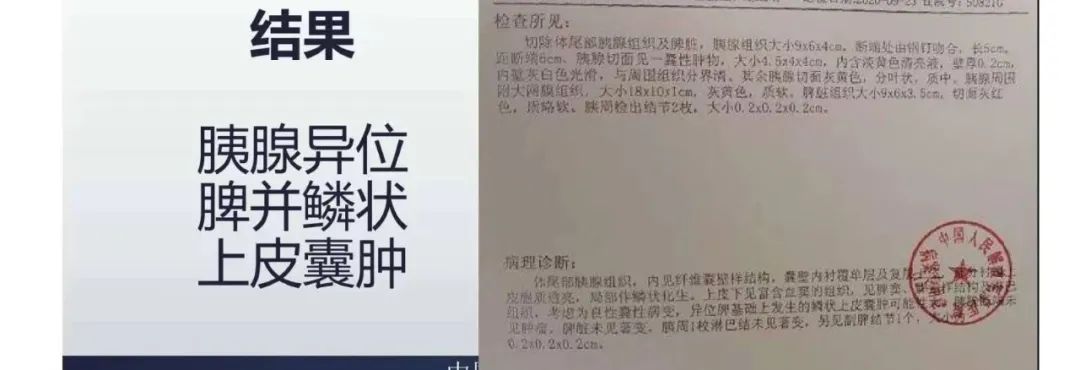 影像PPT - 【病例】胰腺异位副脾并上皮囊肿1例影像表现-12