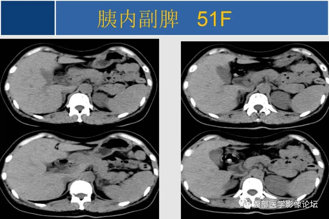 影像PPT - 【病例】胰腺异位副脾并上皮囊肿1例影像表现-38