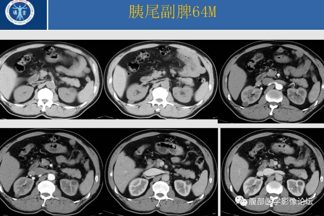 影像PPT - 【病例】胰腺异位副脾并上皮囊肿1例影像表现-40
