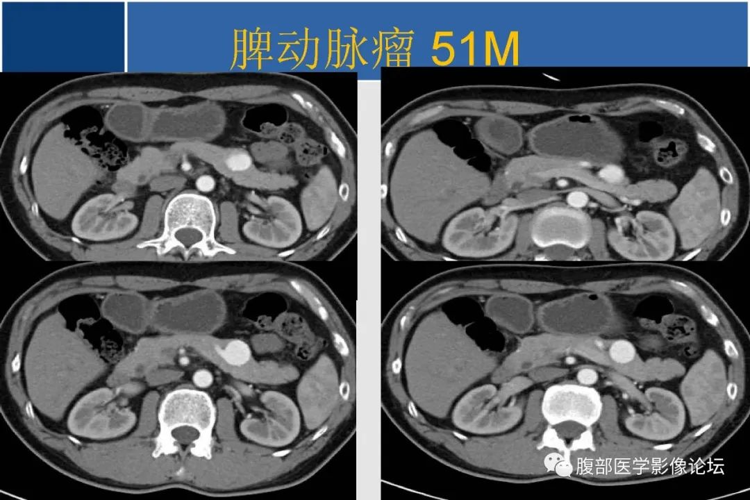 影像PPT - 【病例】胰腺异位副脾并上皮囊肿1例影像表现-45