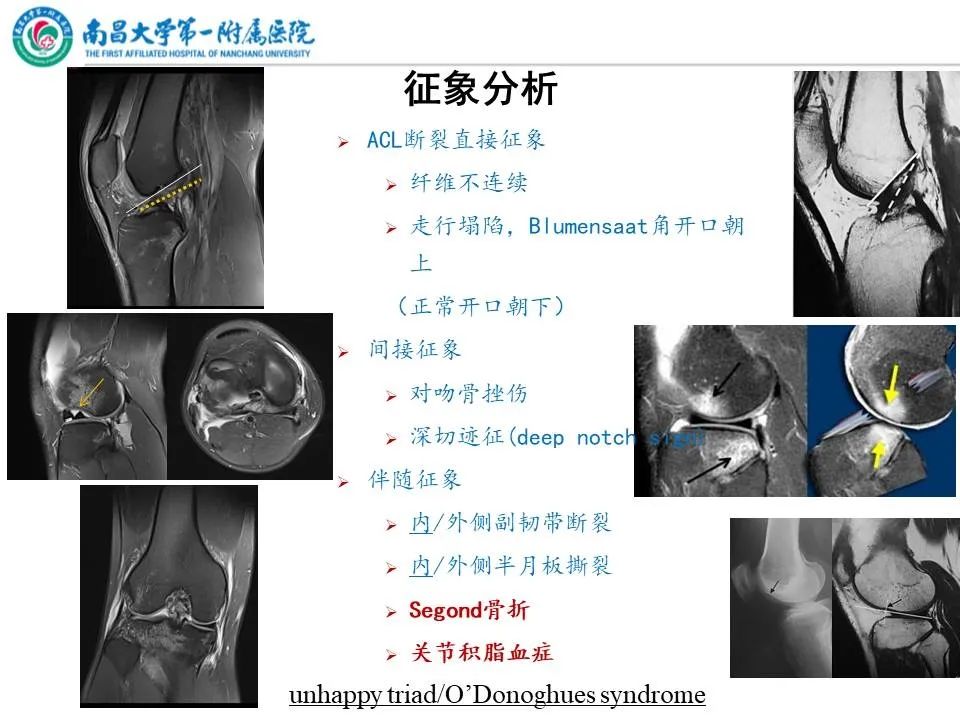 影像PPT - 【PPT】那些年可能错过的膝关节损伤-5