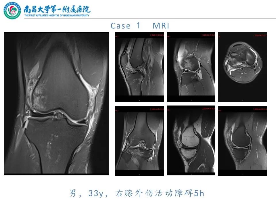 影像PPT - 【PPT】那些年可能错过的膝关节损伤-3