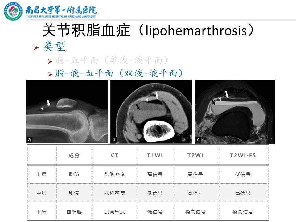 影像PPT - 【PPT】那些年可能错过的膝关节损伤-9