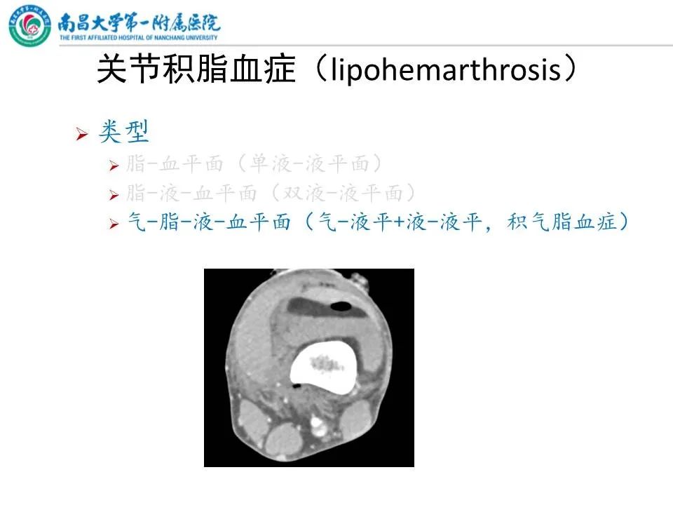 影像PPT - 【PPT】那些年可能错过的膝关节损伤-10