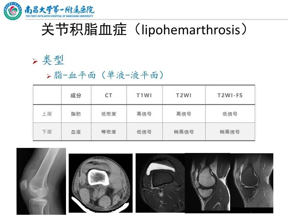影像PPT - 【PPT】那些年可能错过的膝关节损伤-8