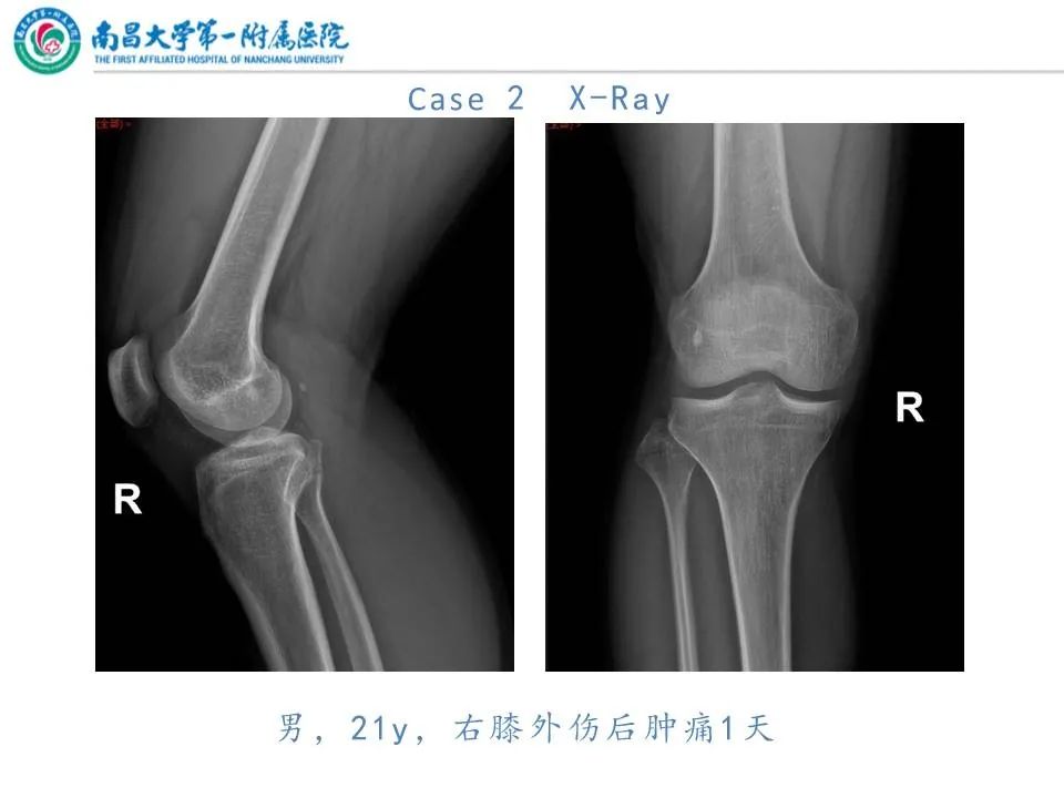 影像PPT - 【PPT】那些年可能错过的膝关节损伤-13