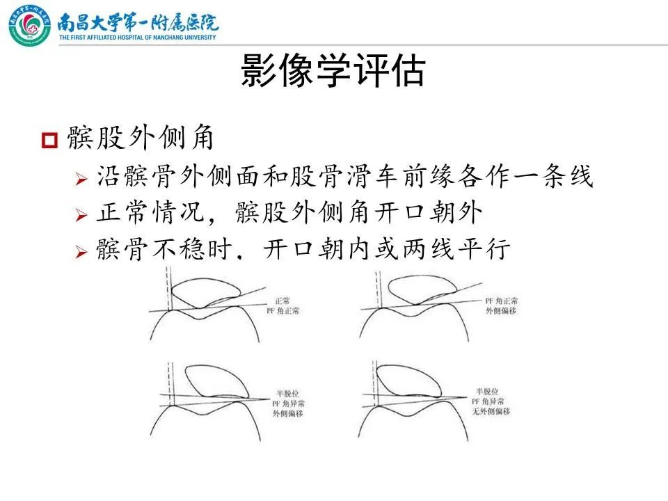 影像PPT - 【PPT】那些年可能错过的膝关节损伤-27