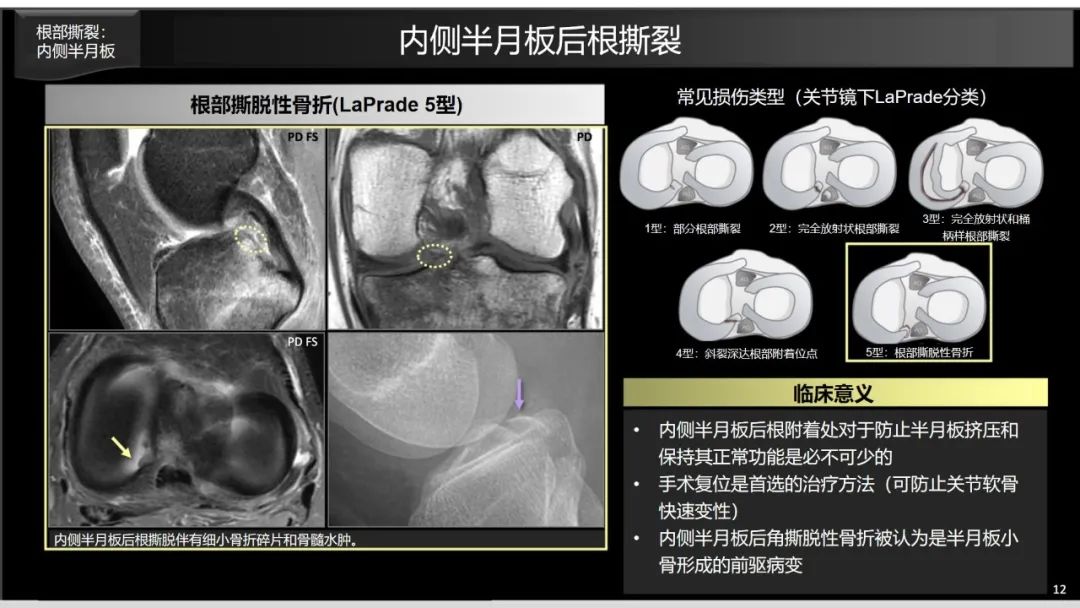 影像PPT - 【PPT】半月板根部,Ramp区,修复,及其后遗症-4 影像PPT - 【PPT】半月板根部,Ramp区,修复,及其后遗症-4
