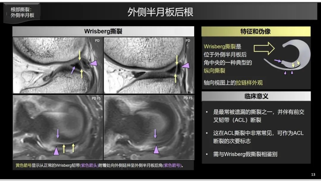 影像PPT - 【PPT】半月板根部,Ramp区,修复,及其后遗症-8 影像PPT - 【PPT】半月板根部,Ramp区,修复,及其后遗症-8