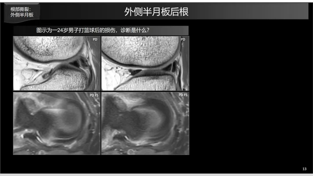 影像PPT - 【PPT】半月板根部,Ramp区,修复,及其后遗症-6 影像PPT - 【PPT】半月板根部,Ramp区,修复,及其后遗症-6