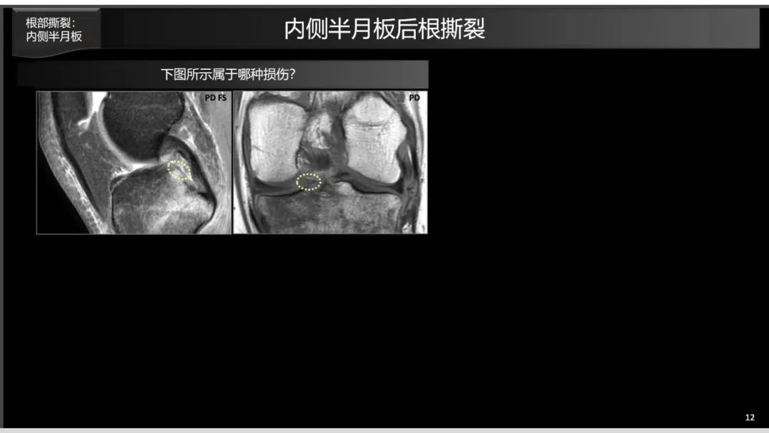 影像PPT - 【PPT】半月板根部,Ramp区,修复,及其后遗症-2 影像PPT - 【PPT】半月板根部,Ramp区,修复,及其后遗症-2