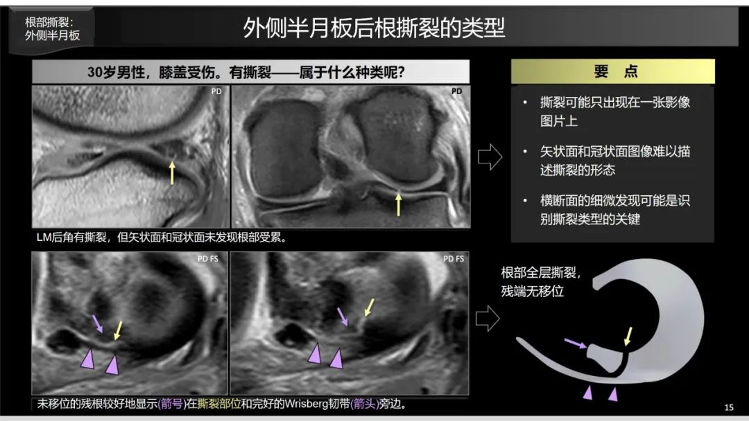 影像PPT - 【PPT】半月板根部,Ramp区,修复,及其后遗症-12 影像PPT - 【PPT】半月板根部,Ramp区,修复,及其后遗症-12