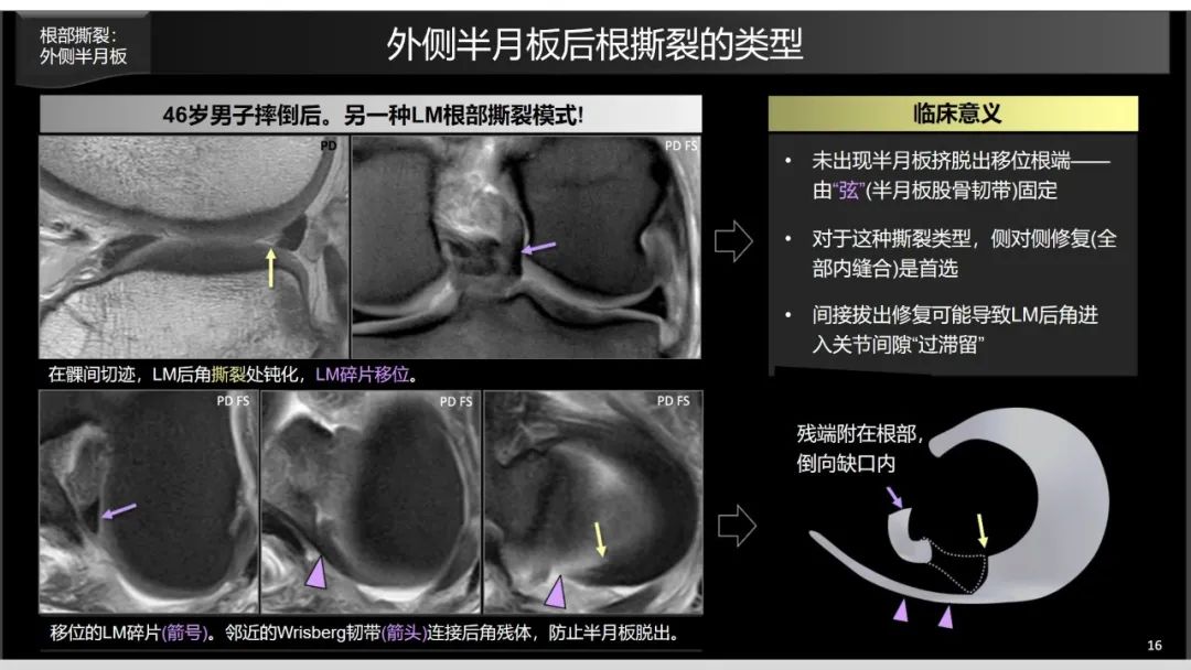 影像PPT - 【PPT】半月板根部,Ramp区,修复,及其后遗症-14 影像PPT - 【PPT】半月板根部,Ramp区,修复,及其后遗症-14