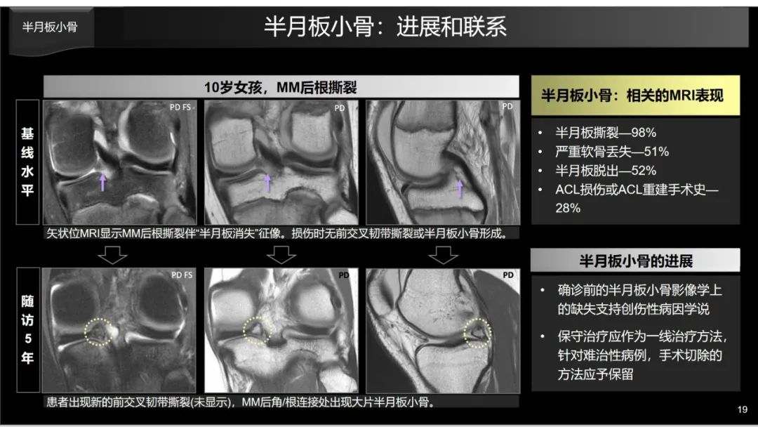 影像PPT - 【PPT】半月板根部,Ramp区,修复,及其后遗症-20 影像PPT - 【PPT】半月板根部,Ramp区,修复,及其后遗症-20