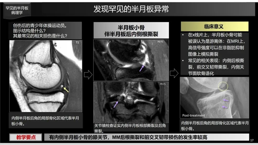 影像PPT - 【PPT】半月板根部,Ramp区,修复,及其后遗症-16 影像PPT - 【PPT】半月板根部,Ramp区,修复,及其后遗症-16
