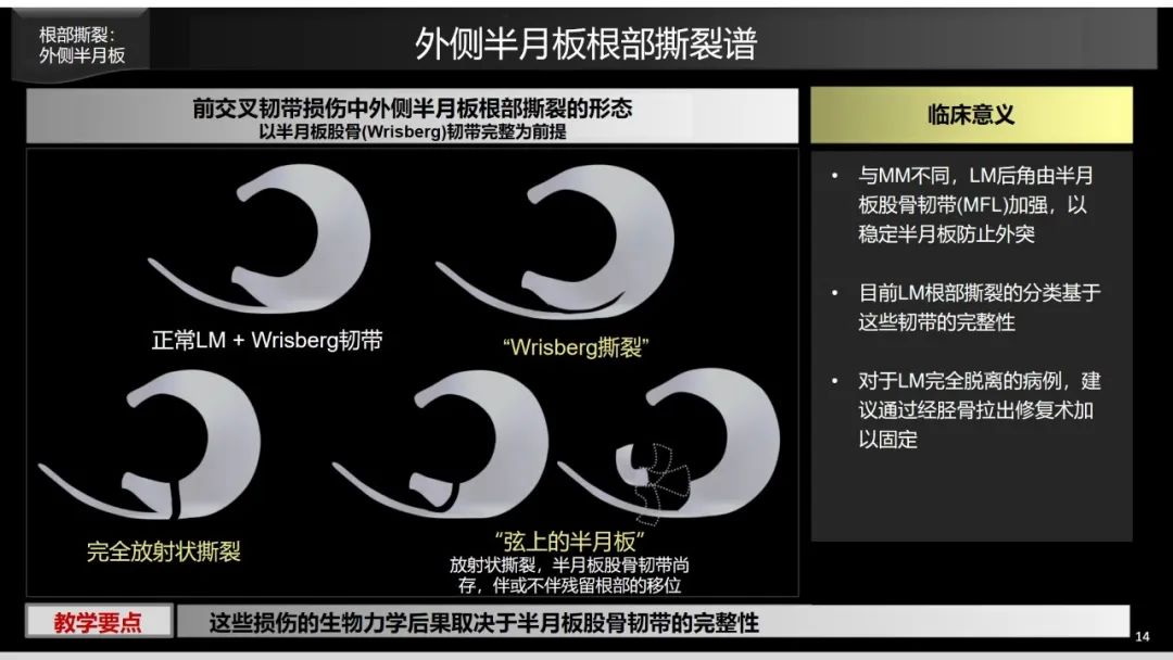 影像PPT - 【PPT】半月板根部,Ramp区,修复,及其后遗症-10 影像PPT - 【PPT】半月板根部,Ramp区,修复,及其后遗症-10
