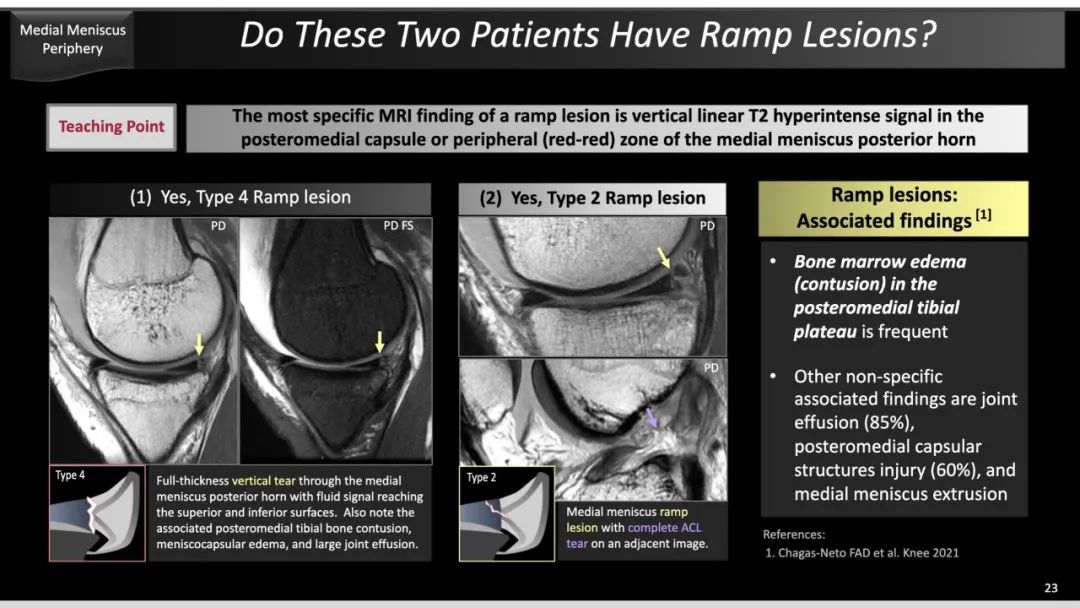 影像PPT - 【PPT】半月板根部,Ramp区,修复,及其后遗症-29 影像PPT - 【PPT】半月板根部,Ramp区,修复,及其后遗症-29