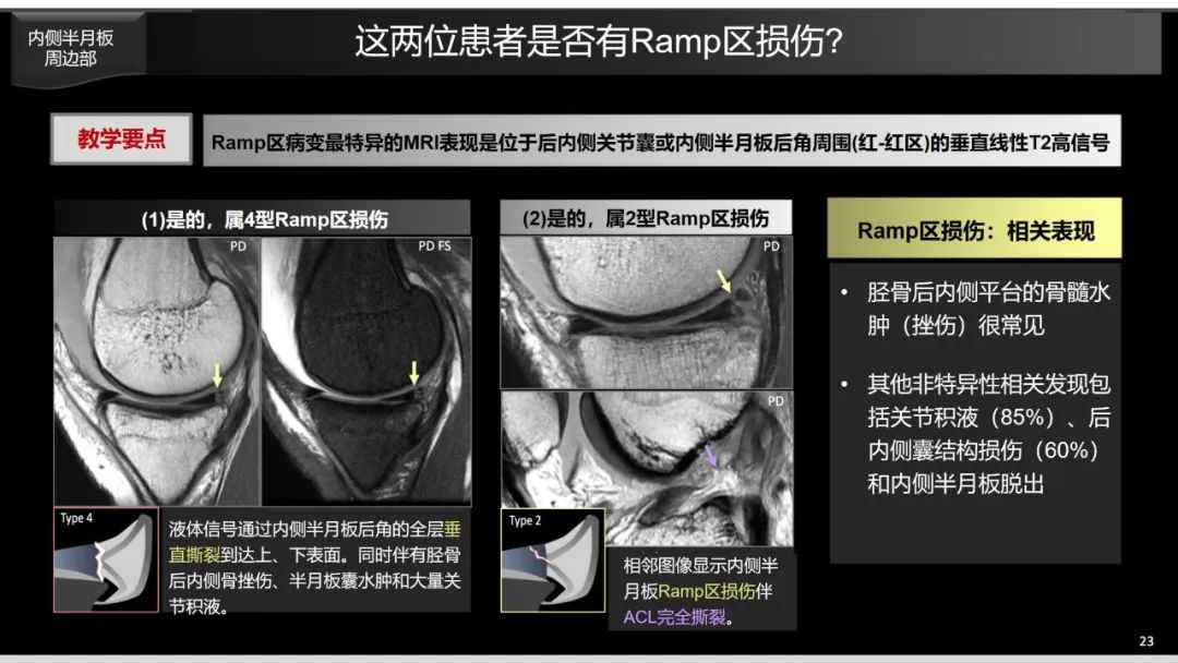 影像PPT - 【PPT】半月板根部,Ramp区,修复,及其后遗症-30 影像PPT - 【PPT】半月板根部,Ramp区,修复,及其后遗症-30