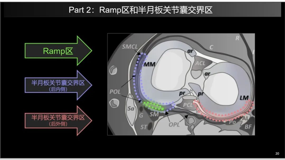 影像PPT - 【PPT】半月板根部,Ramp区,修复,及其后遗症-3 影像PPT - 【PPT】半月板根部,Ramp区,修复,及其后遗症-3